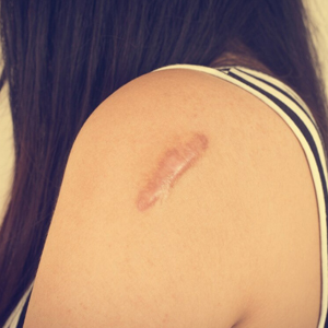 Keloid Surgery