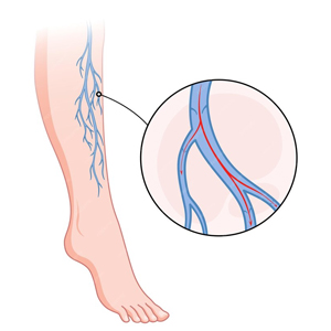 Vascular Malformation